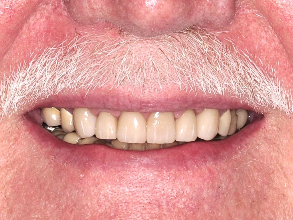A man with a white mustache smiling with whitened teeth
