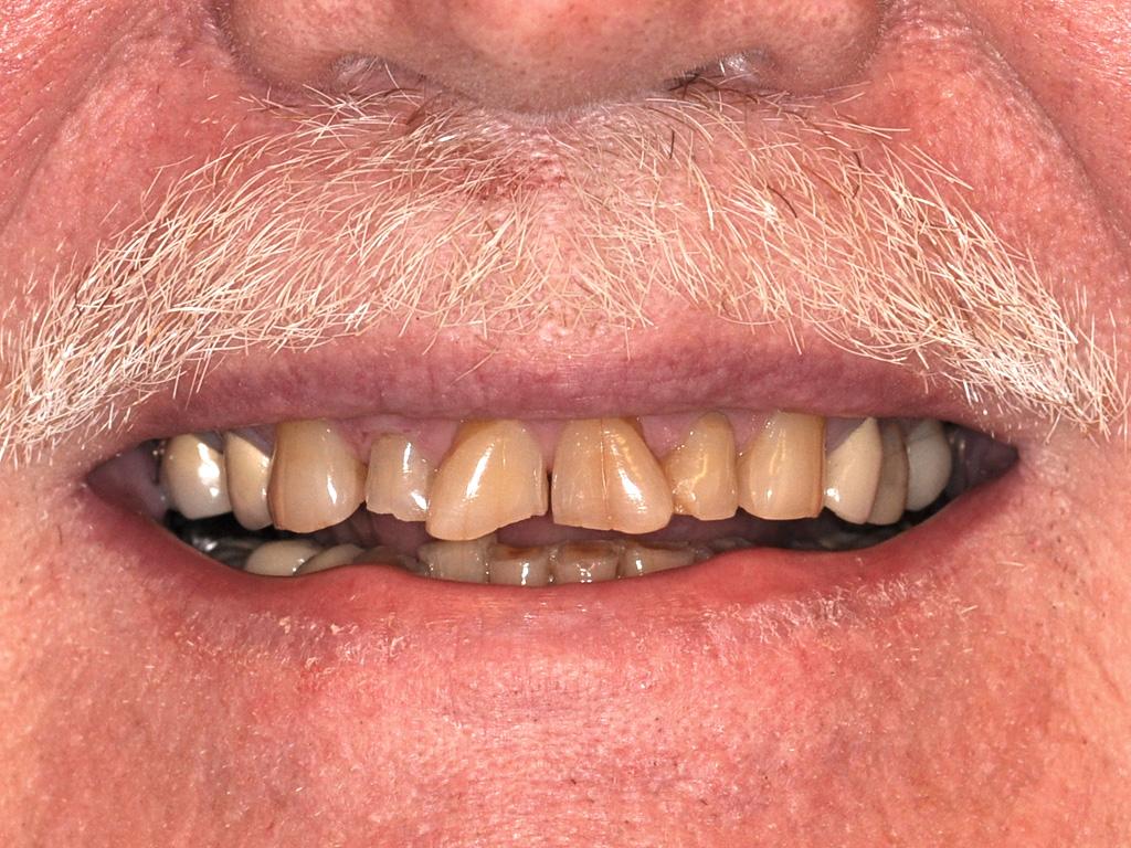 A man with a white mustache smiling with damaged teeth
