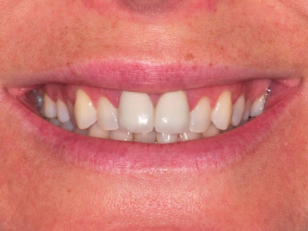 A woman smiling with clean straight teeth