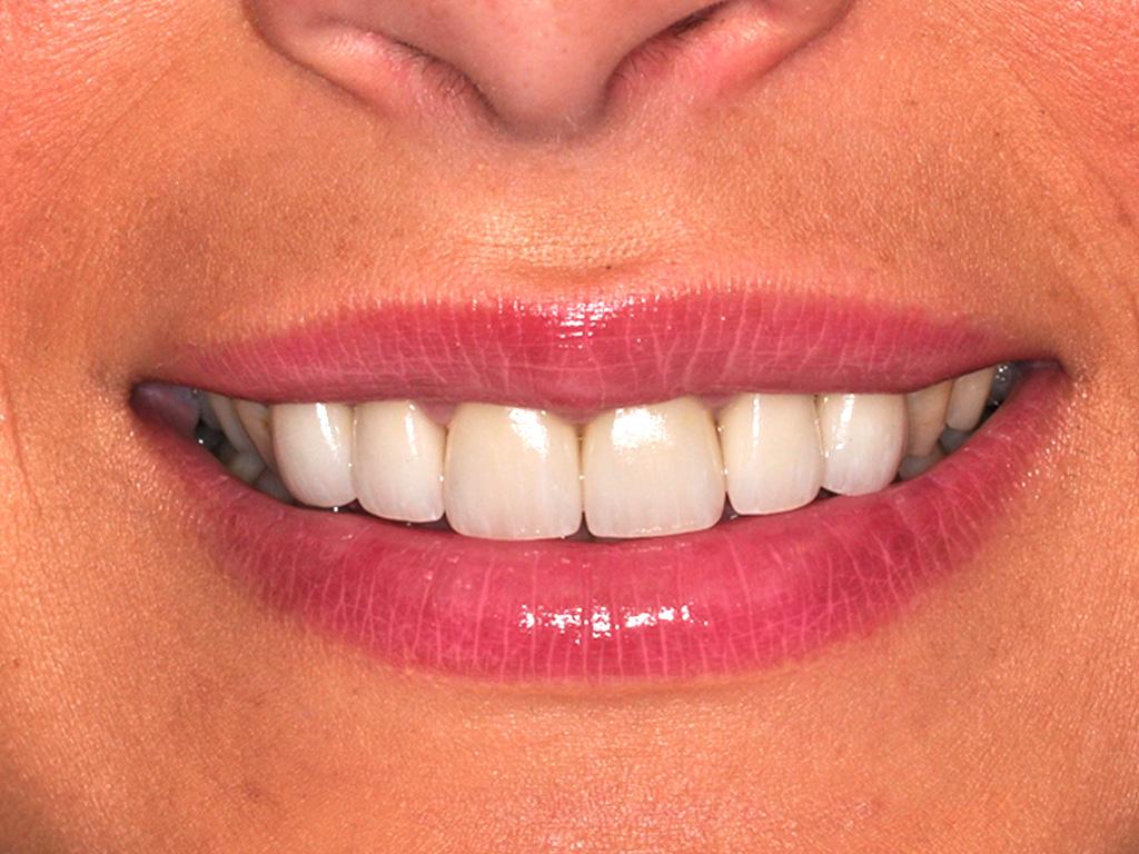 A woman smiling with straightened teeth