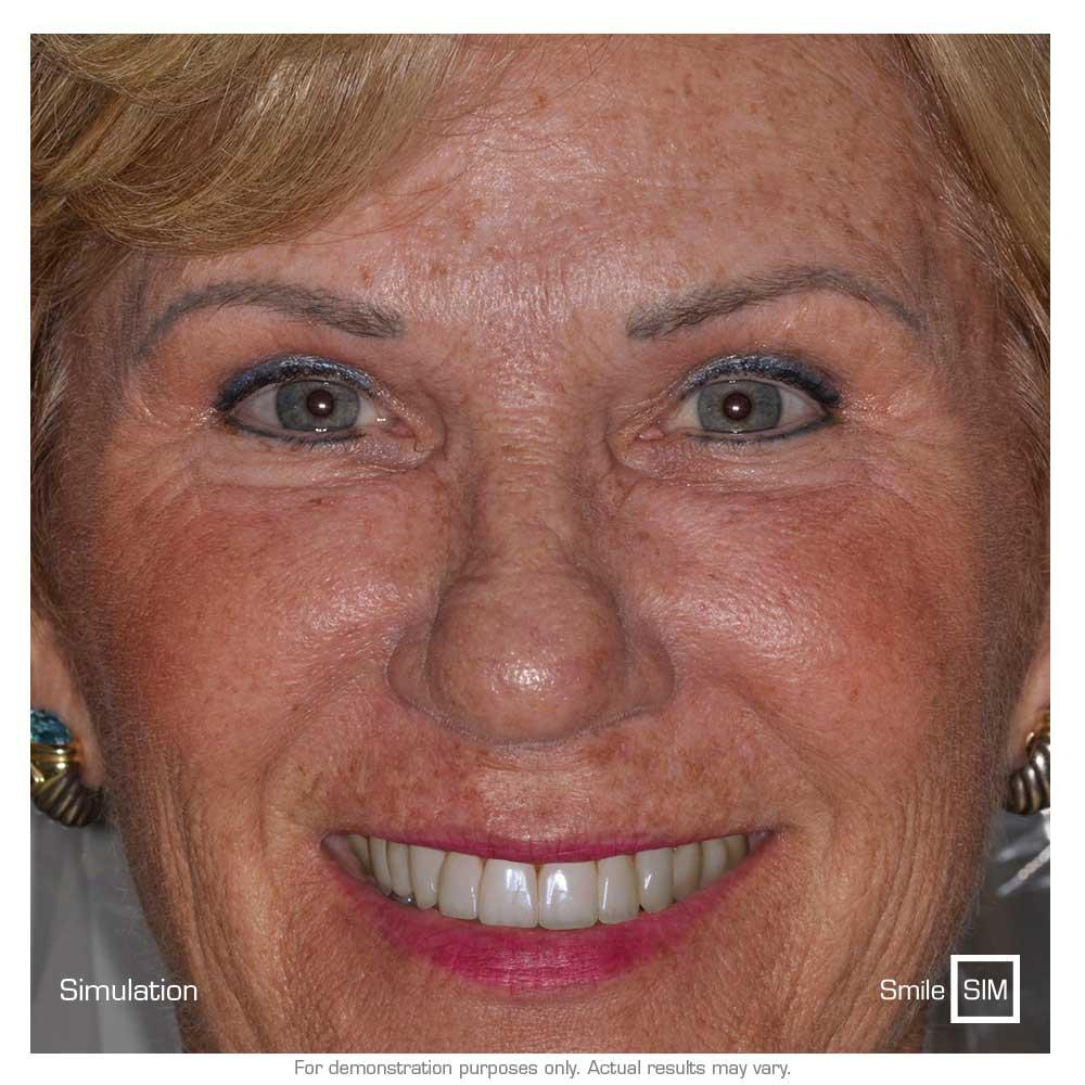 A woman smiling with teeth whitening simulated