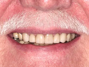A man with a white mustache smiling with whitened teeth