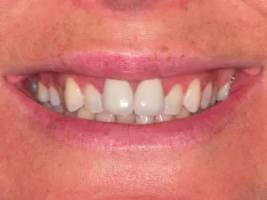 A woman smiling with clean straight teeth