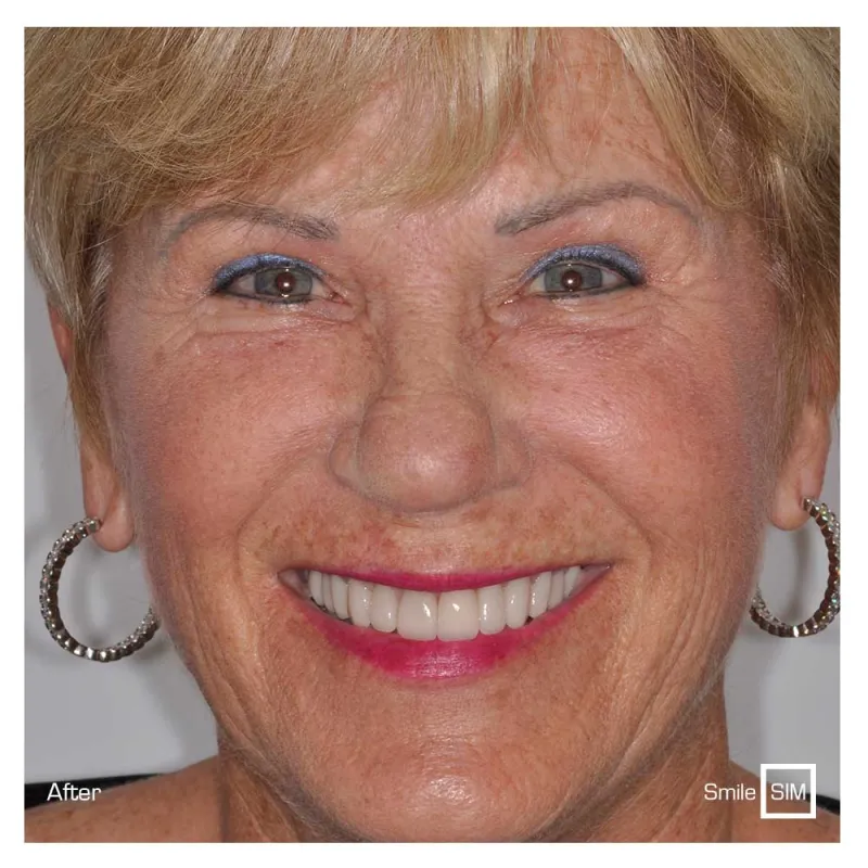 A woman smiling after teeth whitening