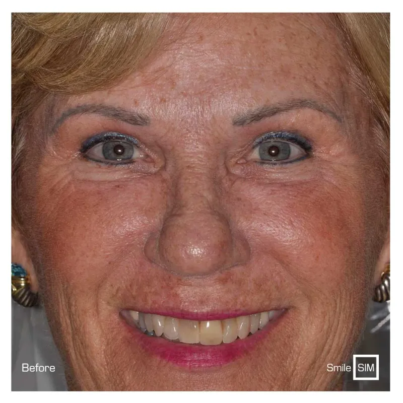 A woman smiling before teeth whitening