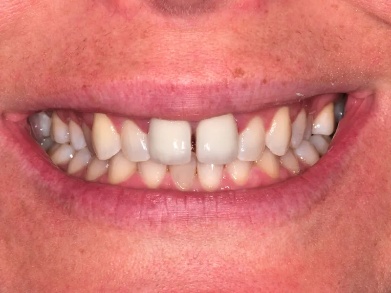 A before photo of a woman with crooked teeth